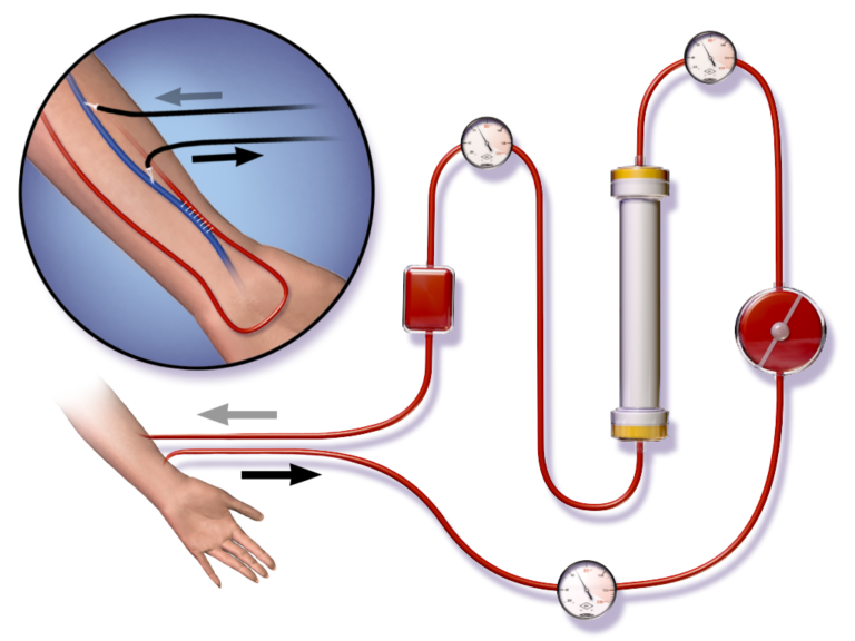 The Hemodialysis Process United Dialysis Center