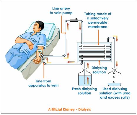 What is Kidney Dialysis?